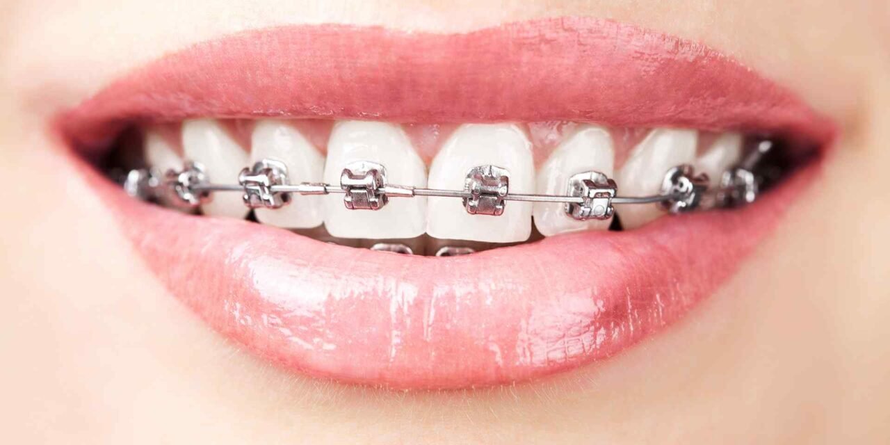 Aligneurs ou bagues céramiques : que choisir ?